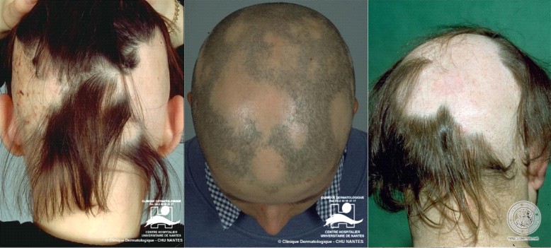 Alopecia Areata